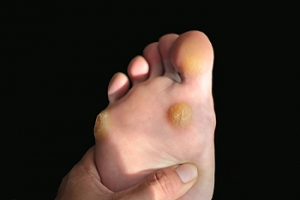 What Are Plantar Warts?