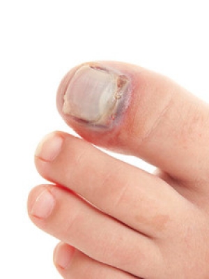 How Broken Toes May Happen
